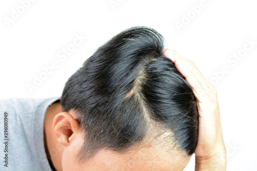 Hair loss everyday, serious problem of daily life.