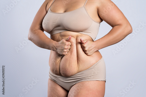 Tummy tuck, flabby skin on a fat belly, plastic surgery concept photo