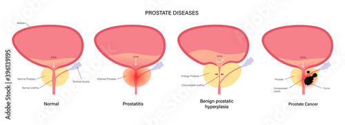 Prostate cancer concept