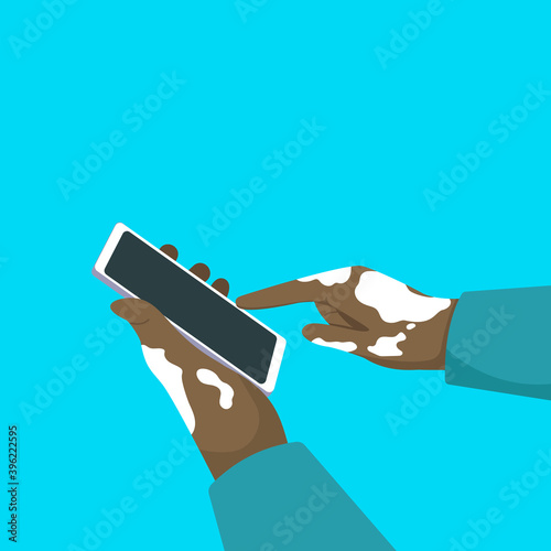 Human hands close-up affected by the Skin Disease Vitiligo use a smartphone. A dark-skinned man with vitiligo. Communication technologies. Vector illustration isolated on a white background