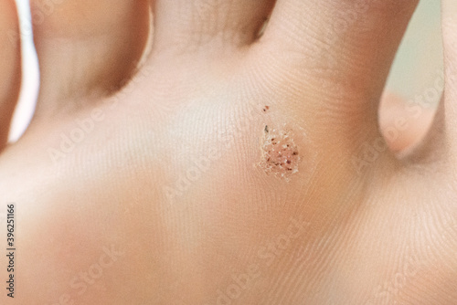 wart on a blunt close-up. Macro shot of human papilloma on the foot.