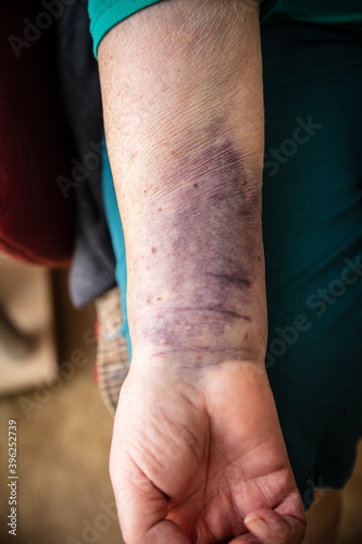 Senior woman with a bruise on the arm, hematoma on skin, healthcare