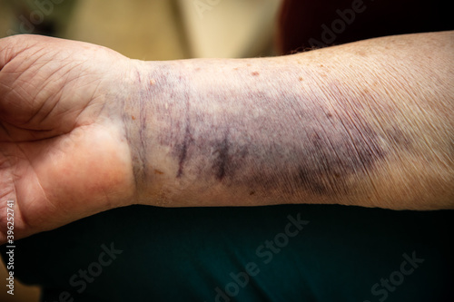 Senior woman arm with a bruise hematoma or haematome on skin photo