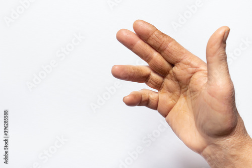 Human hand brush on a white background - a disease of the joint and palm, Dupuytren's contracture, fingers do not bend. Medicine and traumatology, orthopedics photo