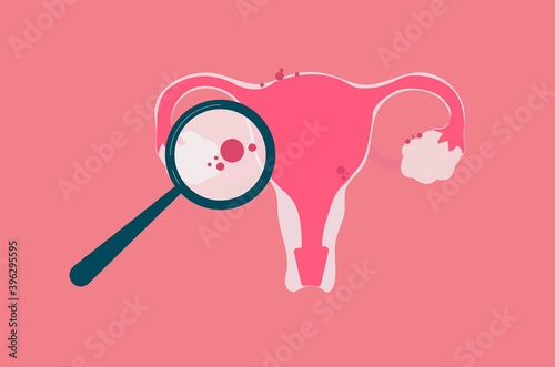 Endometriosis concept illustration for medical content or educational purpose.