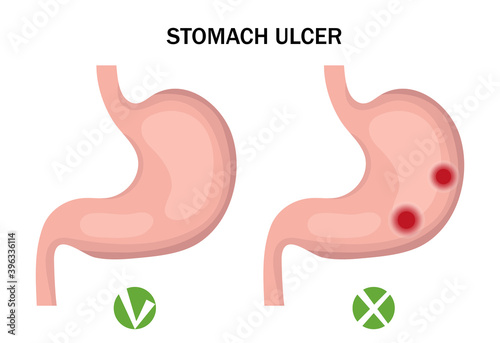 Stomach ulcer and healthy stomach infographics. Medicine concept. Vector illustration