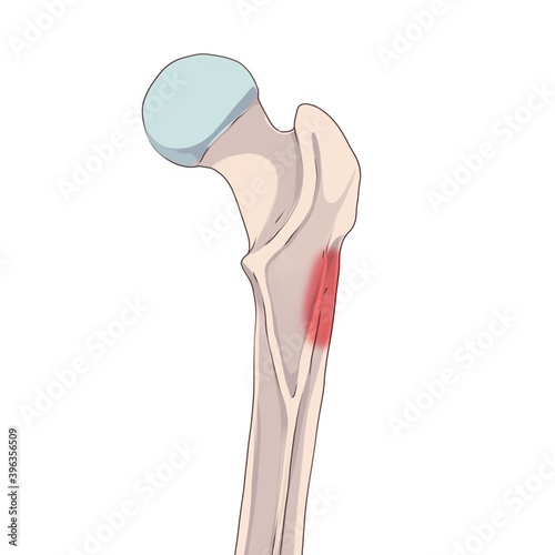 Gluteal tuberosity. The femur, or thigh bone, is the proximal bone of the hindlimb in tetrapod vertebrate, the largest bone of the human body. 
