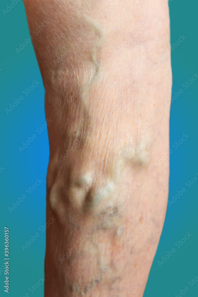 Naklejka premium The old age and sick of a woman. Varicose veins on a legs of old woman on blue. The varicosity, spider veins, edema, illness concept. Senior pensioner woman with hands on legs. Blue studio background.