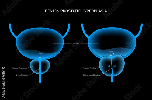 BPH info concept