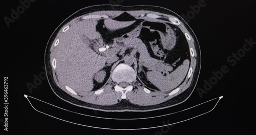 Cineview of CT scan of a patient with common bile duct stone. photo