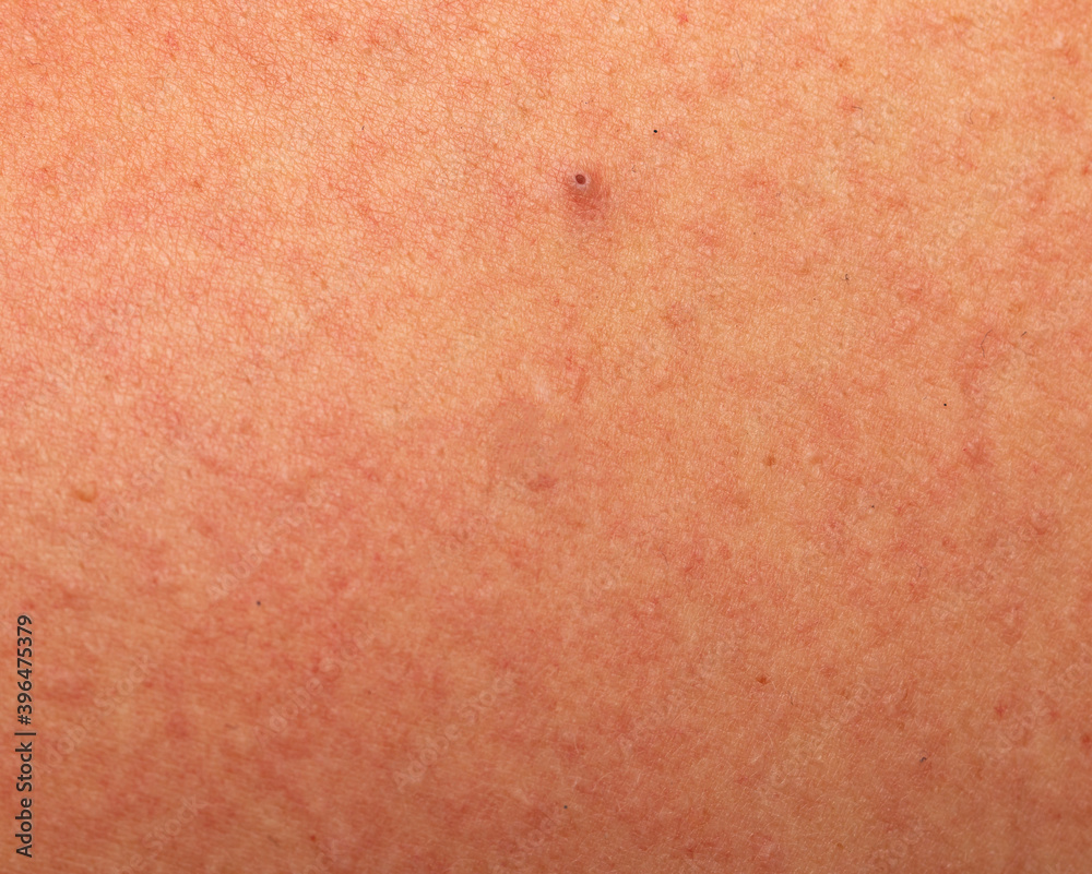 redness on the skin in the form of a rash as a background