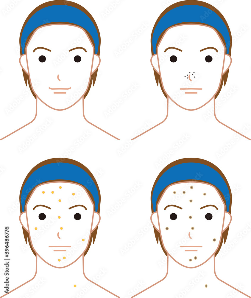 ニキビができた若い男性 ニキビができた若い男性