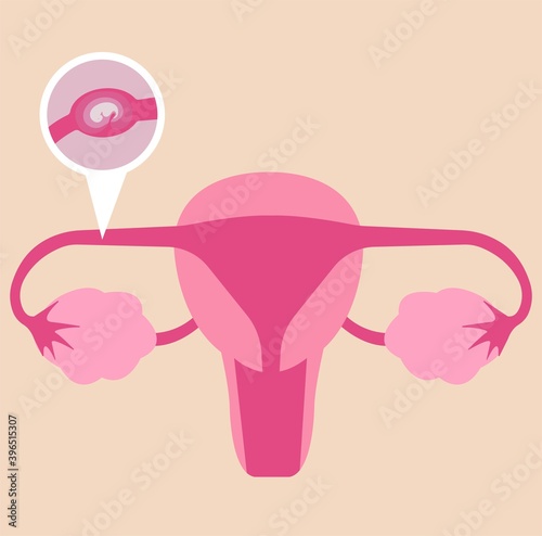 Ectopic pregnancy or fallopian tubes pregnancy.