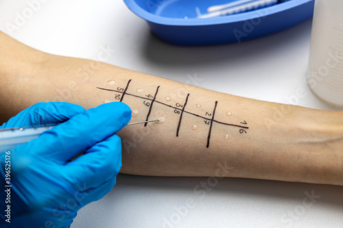 Carta da parati immunologist doing skin prick allergy test on a patient arm