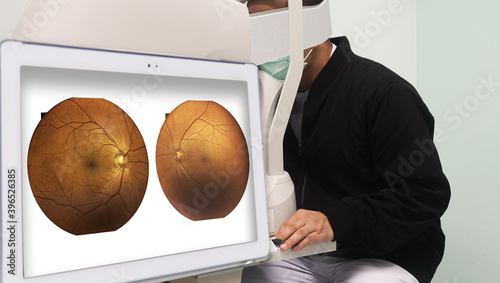 Patients are examining their eyesight with a fundus non-mydriatic camera in a screening room for patients at risk of diabetes.