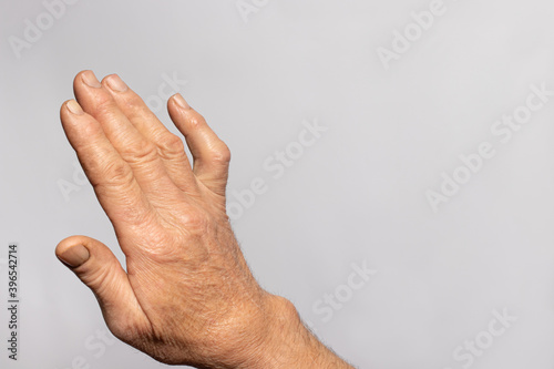 A human hand brush on a gray background with place for text for medicine and traumatology. Ankylosis joint phalanx of the little finger 5 fingers, joint immobility, osteoarthritis and arthritis