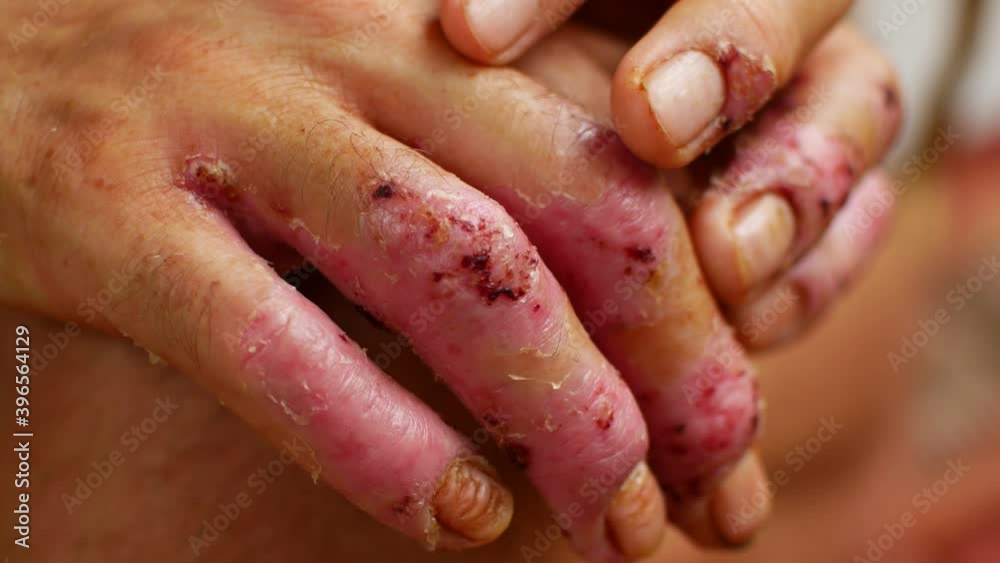 Terrible ulcers on the hands, illness Terrible ulcers on the hands, illness