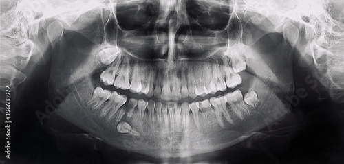 x-ray of the mouth with a problem tooth photo