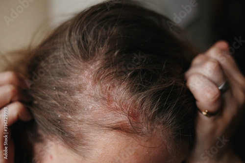 Psoriasis Vulgaris, psoriatic skin disease in hair, skin patches are typicaly red, itchy, and scaly, macro with narrow focus