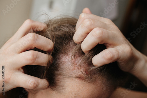 Psoriasis Vulgaris, psoriatic skin disease in head hair, skin patches are typicaly red, itchy, and scaly. Woman furiously scratching her head