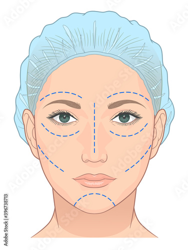 Dotted lines on the face for plastic surgery