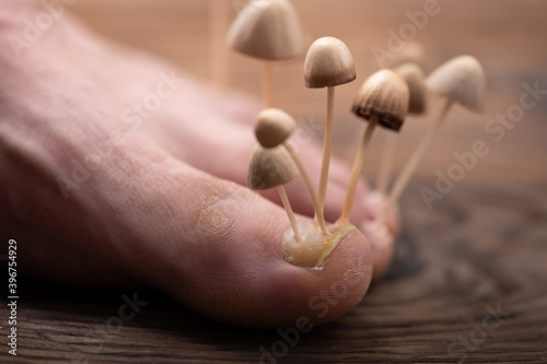 Fungi grow from the nail plates on the foot. Concept of nail fungus, skin and nail infections. Foot with fungus close-up in the background light. photo