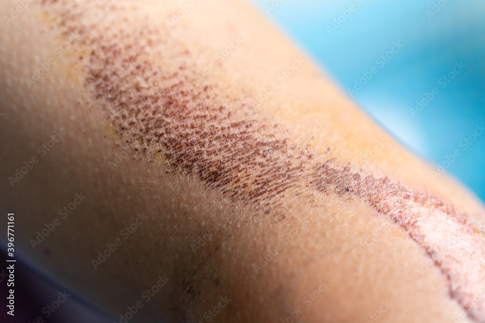 Fototapeta premium Closeup injured, Fresh wounds from accident. 