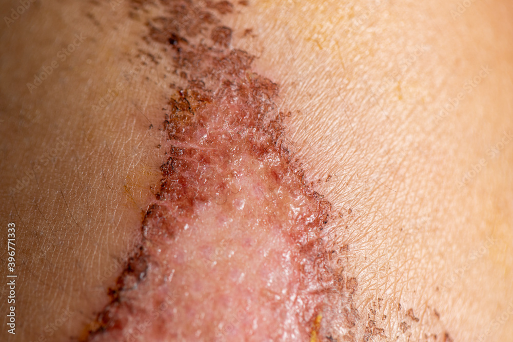 Fototapeta premium Closeup injured, Fresh wounds from accident. 