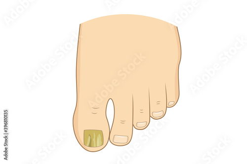 Toenail green mycosis vector illustration.