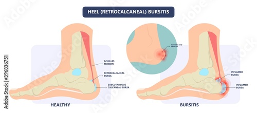 Hip pain knee heel cuff bone gout drug Feet bursa joint elbow treat tears drain shots fluid Ankle bursae tendon muscle trauma injury septic frozen tennis therapy rotator disease greater relieve