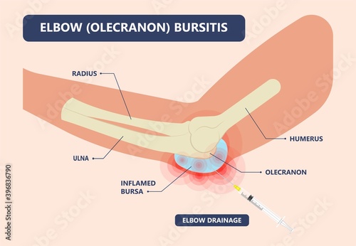 Hip pain knee heel cuff bone gout drug Feet bursa joint elbow treat tears drain shots fluid Ankle bursae tendon muscle trauma injury septic frozen tennis therapy rotator disease greater relieve