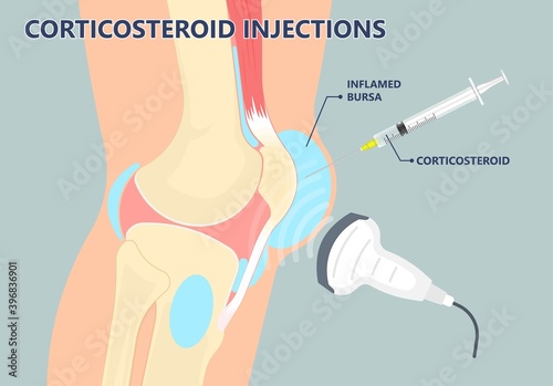 Hip pain knee heel cuff bone gout drug Feet bursa joint elbow treat tears drain shots fluid Ankle bursae tendon muscle trauma injury septic frozen tennis therapy rotator disease greater relieve