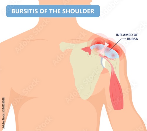 Hip pain knee heel cuff bone gout drug Feet bursa joint elbow treat tears drain shots fluid Ankle bursae tendon muscle trauma injury septic frozen tennis therapy rotator disease greater relieve
