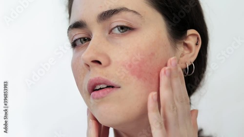 Close-up portrait of a young woman groping her face and showing redness on her cheeks. White background. The concept of rosacea and couperose