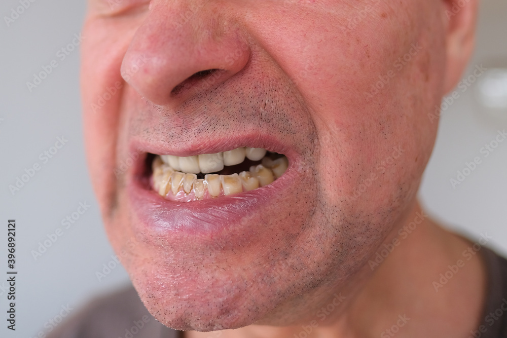 face of a European old man close-up, wrinkles on the aging skin, bares his teeth, makes grimaces, opening his mouth, the concept of mental health, cosmetology, age-related changes face of a European old man close-up, wrinkles on the aging skin, bares his teeth, makes grimaces, opening his mouth, the concept of mental health, cosmetology, age-related changes