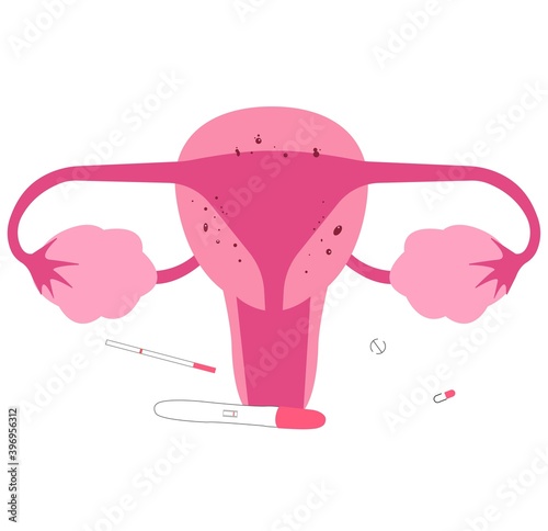 Adenomyosis, one of medical condition of female reproduction organ. Infertility causes.