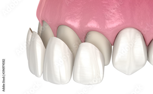 Veneer installation procedure over central incisor and lateral incisor. Medically accurate tooth 3D illustration