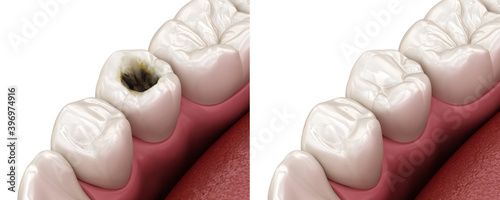 Fotografie, Obraz Premolar tooth restoration with filling after caries damage