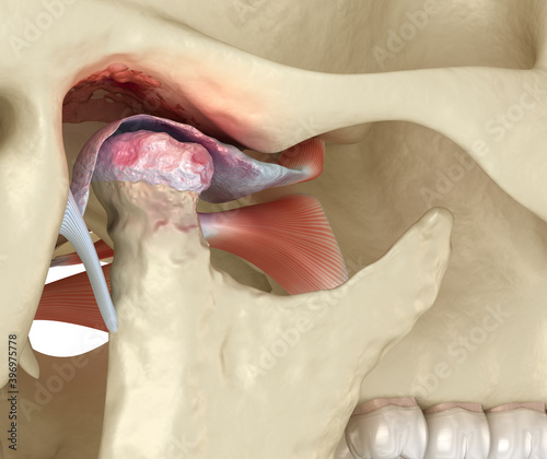 Temporomandibular joints arthritis and dislocated articular disc. Medically accurate 3D illustration. photo