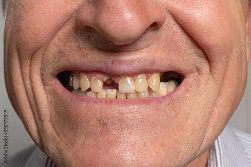 The toothless smile of an old European man on a gray background. Dentistry for pensioners, happy old age, dentist installing dentures