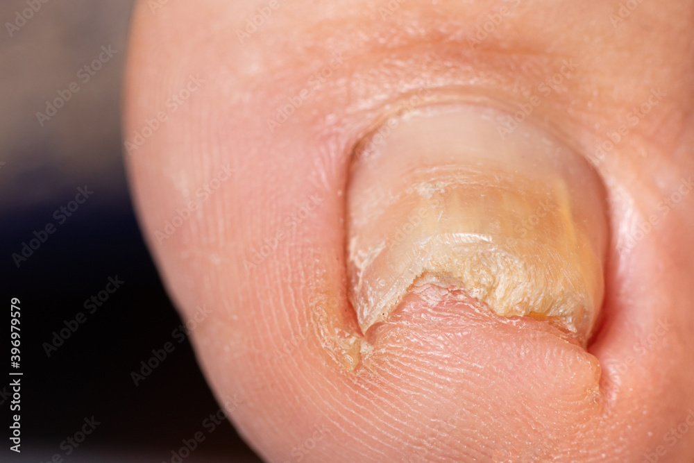Ingrown toenail from wearing tight shoes. Nail fungus macro photo