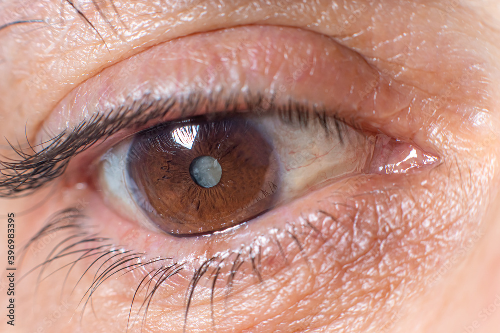 Macro photos of the human eye cataract clouding of the lens