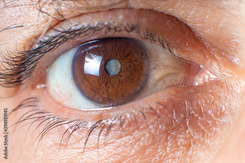 Macro photos of the human eye - cataract clouding of the lens, deterioration of vision. Treatment, surgery and ophthalmology