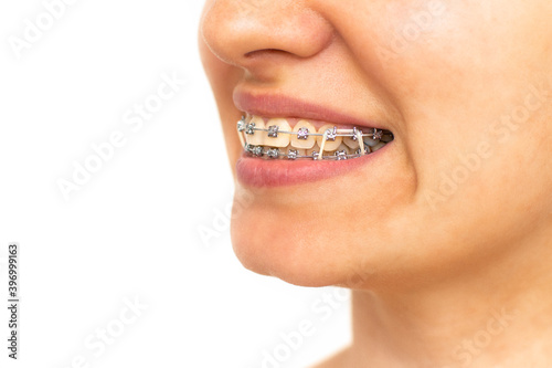 Closeup of woman with braces on teeth with elastics. Smiling face with braces isolated on white background. Orthodontic treatment. Closeup of healthy female mouth with metal braces. 
