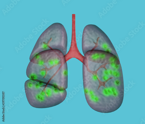 Virus pneumonia, lungs infections, 3d render