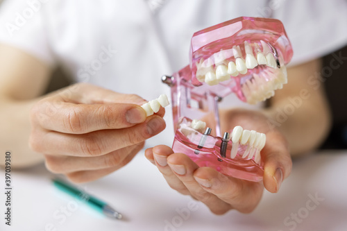dentist implantologist showing dental bridge implant technology on human tooth jaw model photo