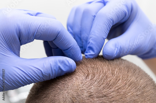 Doctor checks a head hair for nits and lice. A dermatologist examines the condition of the scalp, hair follicles, baldness, hair loss problems, eczema and dandruff. Hands in medical latex gloves