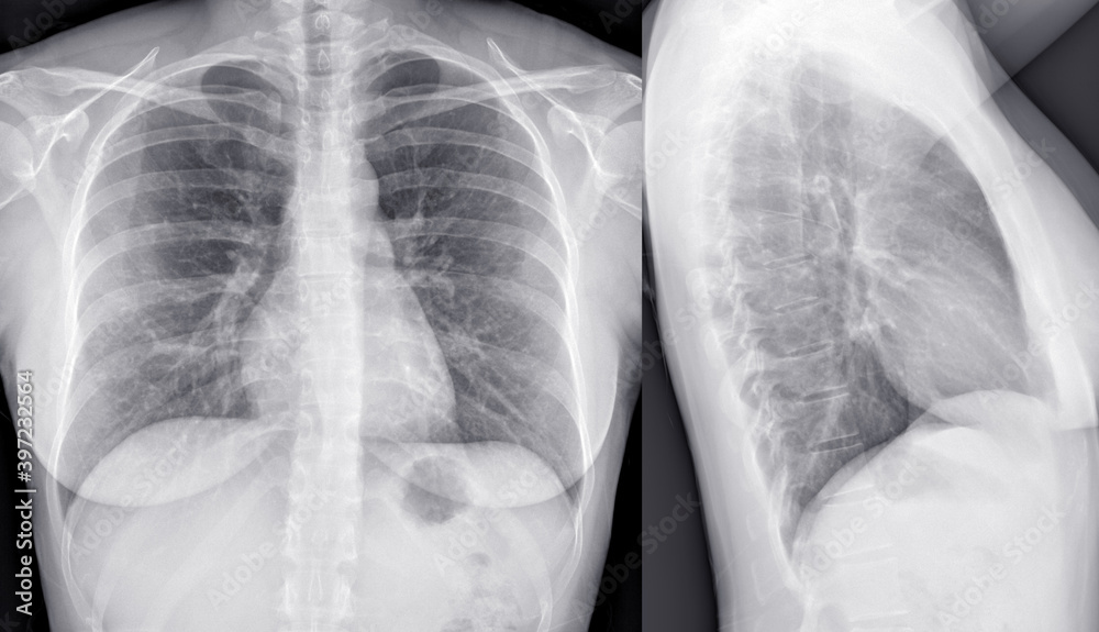 Woman chest xray. Frontal and lateral view. Stock Photo Adobe Stock
