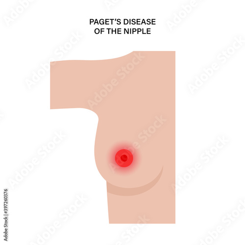 Breast disease concept