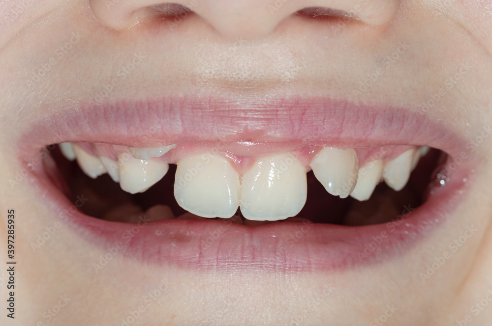 Obraz premium Smile of a boy with teeth growth defects.
